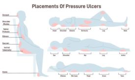 Understanding Pressure Ulcers